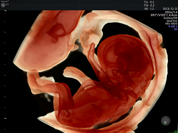 3D Ultraschall Darstellung 10 SSW - Frauenarzt Frauenärztin Gynäkologie Pränataldiagnostik Ersttrimesterscreening DEGUM II Essen