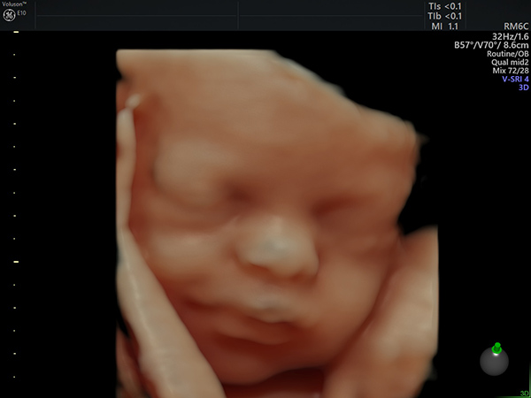 3D Ultraschall Fetales Gesicht 28 SSW - Frauenarzt Frauenärztin Gynäkologie Pränataldiagnostik Ersttrimesterscreening DEGUM II Essen