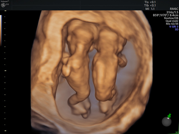 3D Ultraschall Zwillingsschwangerschaft 11 SSW - Frauenarzt Frauenärztin Gynäkologie Pränataldiagnostik Ersttrimesterscreening DEGUM II Essen